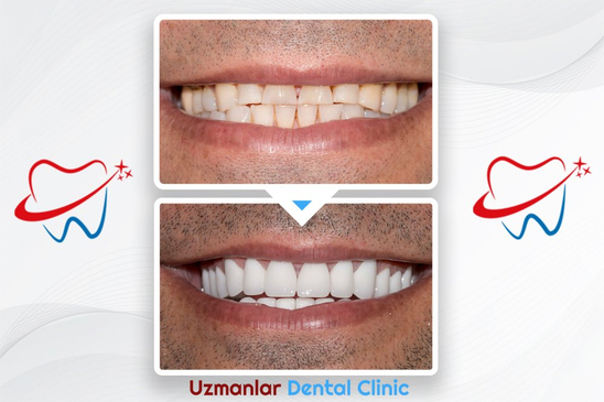 Slider image (8) Uzmanlar Dental Clinic